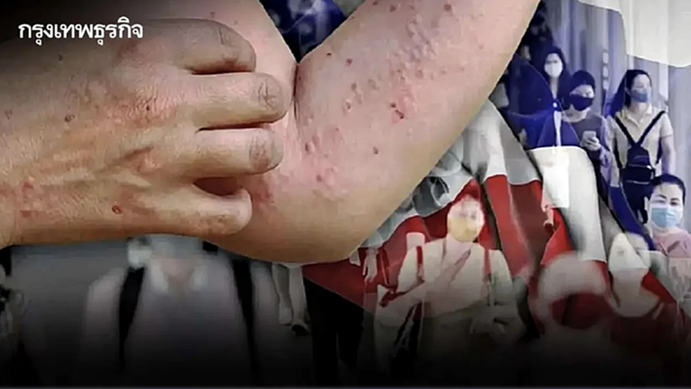 คร. เฝ้าระวัง 'โรคฝีดาษวานร' กทม. มีผู้ป่วยสูงสุด เป็นเพศชายถึง 97%