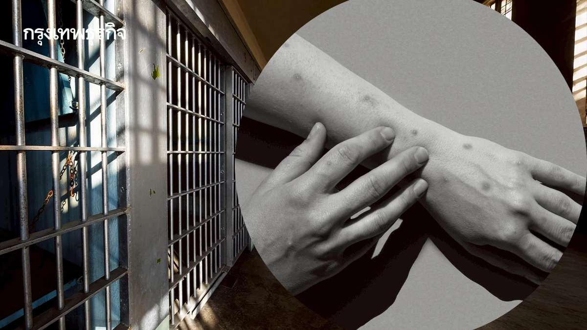 'ฝีดาษวานร' คร่าชีวิต 1 รายในเรือนจำ สั่งเฝ้าระวังเข้มกลุ่มเสี่ยง