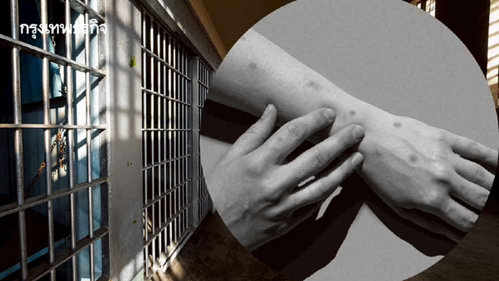 'ฝีดาษวานร' คร่าชีวิต 1 รายในเรือนจำ สั่งเฝ้าระวังเข้มกลุ่มเสี่ยง