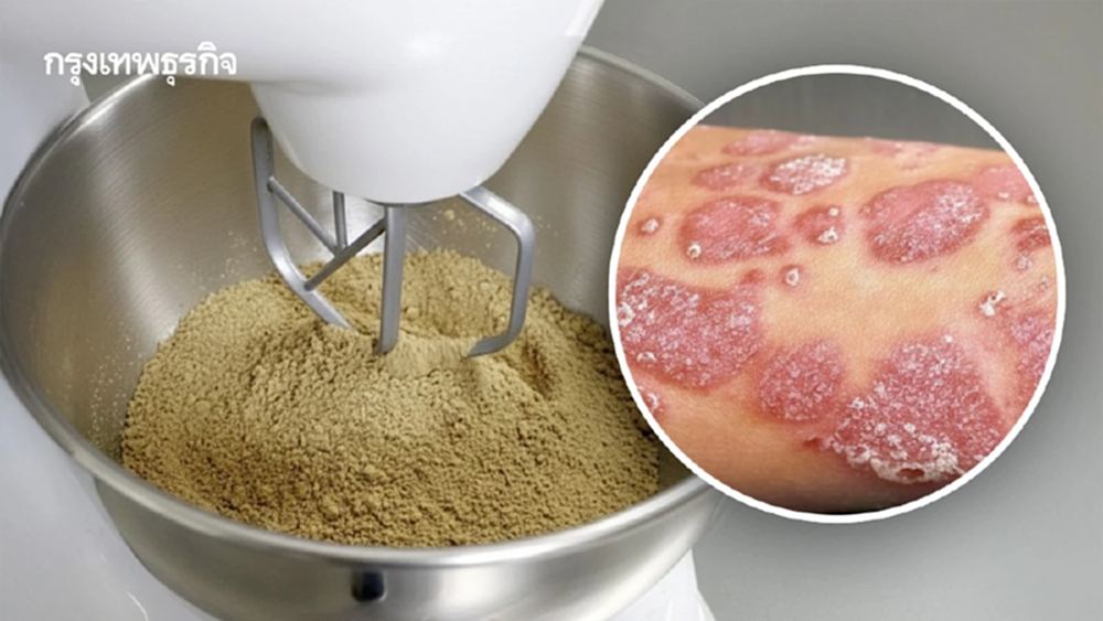 สวก. พัฒนายาสมุนไพรสะเก็ดเงินปรุงเฉพาะราย จ่อดันเข้าบัตรทอง