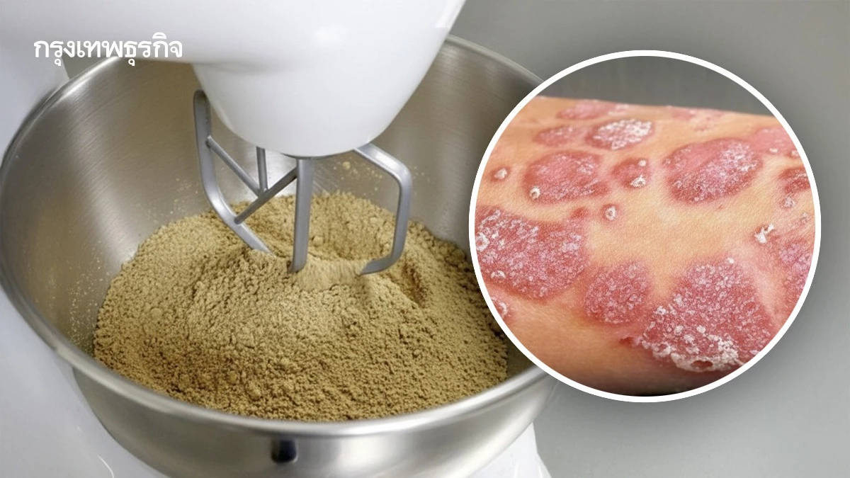 สวก. พัฒนายาสมุนไพรสะเก็ดเงินปรุงเฉพาะราย จ่อดันเข้าบัตรทอง