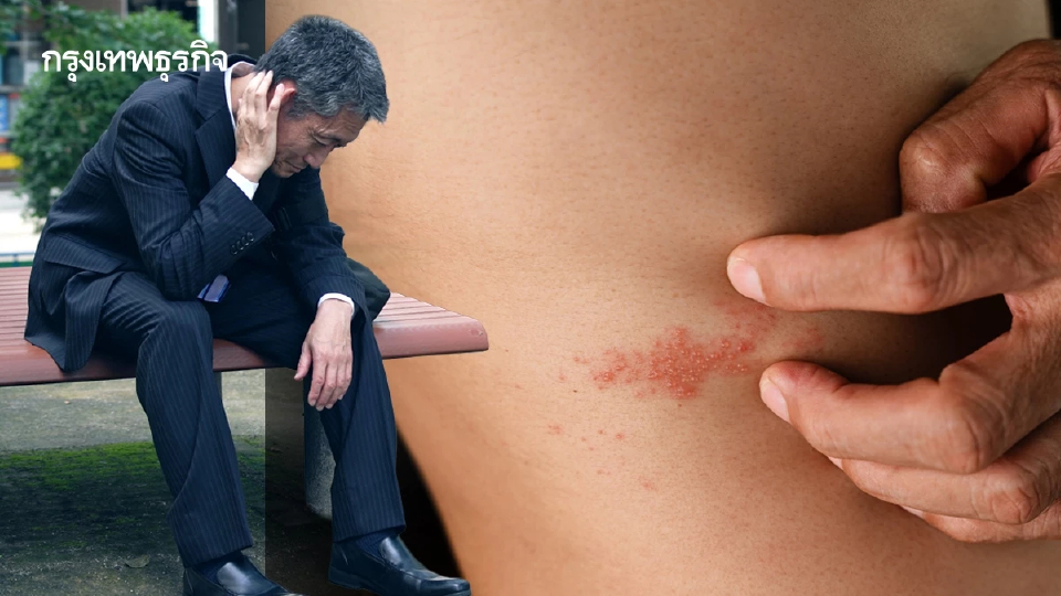 วัย 50+ เกือบ 80% มีโรคเรื้อรัง กังวลงูสวัดกระทบคุณภาพชีวิต