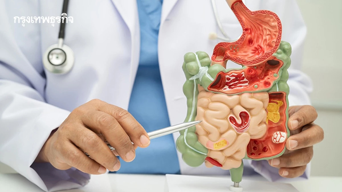 'มะเร็งจิสต์' ในระบบทางเดินอาหาร ระยะแรกมักไม่แสดงอาการ