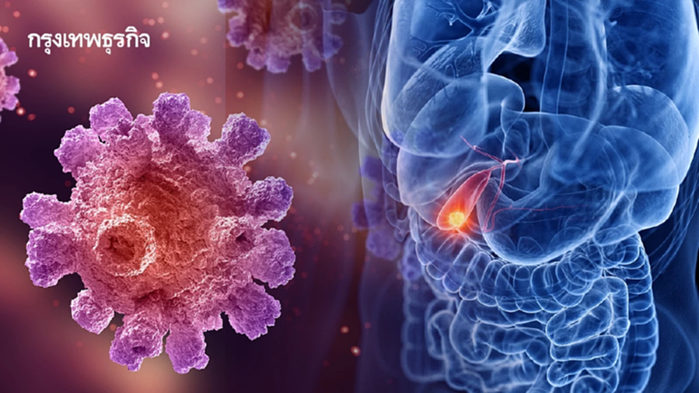 แพทย์เตือน สัญญาณเงียบ มะเร็งถุงน้ำดี หลัง 'จา พนม' ป่วยแล้ว ระยะ 3