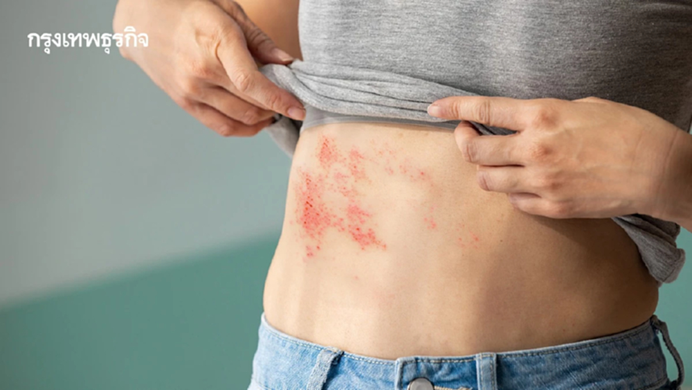 คนไทย 1ใน 3 เสี่ยงเป็นงูสวัด วัย 50+ กลุ่มโรคเรื้อรัง ระวังอาการทรุด