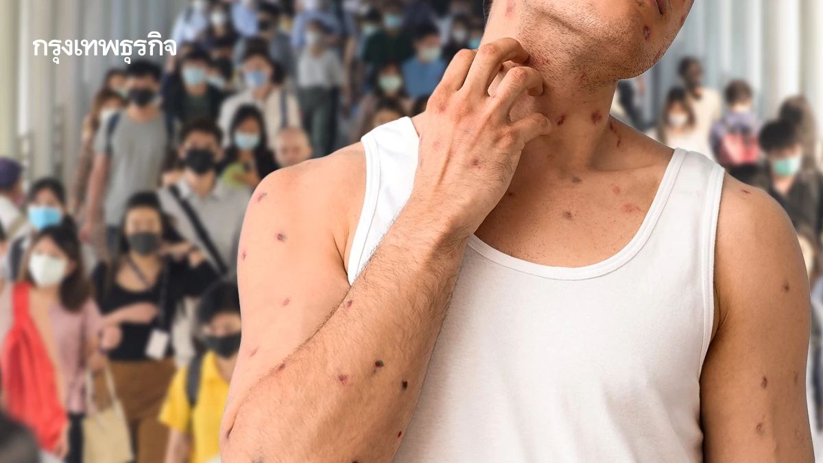 กรมควบคุมโรค เตือน 'โรคสุกใส' ระบาด ป่วยแล้ว 1.3 หมื่นคน พบ 6 คลัสเตอร์