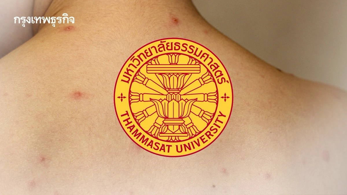 กรมควบคุมโรคเผยผลสอบสวน 'โรคอีสุกอีใส' ป่วยกลุ่มก้อน 2 คณะ มธ.รังสิต