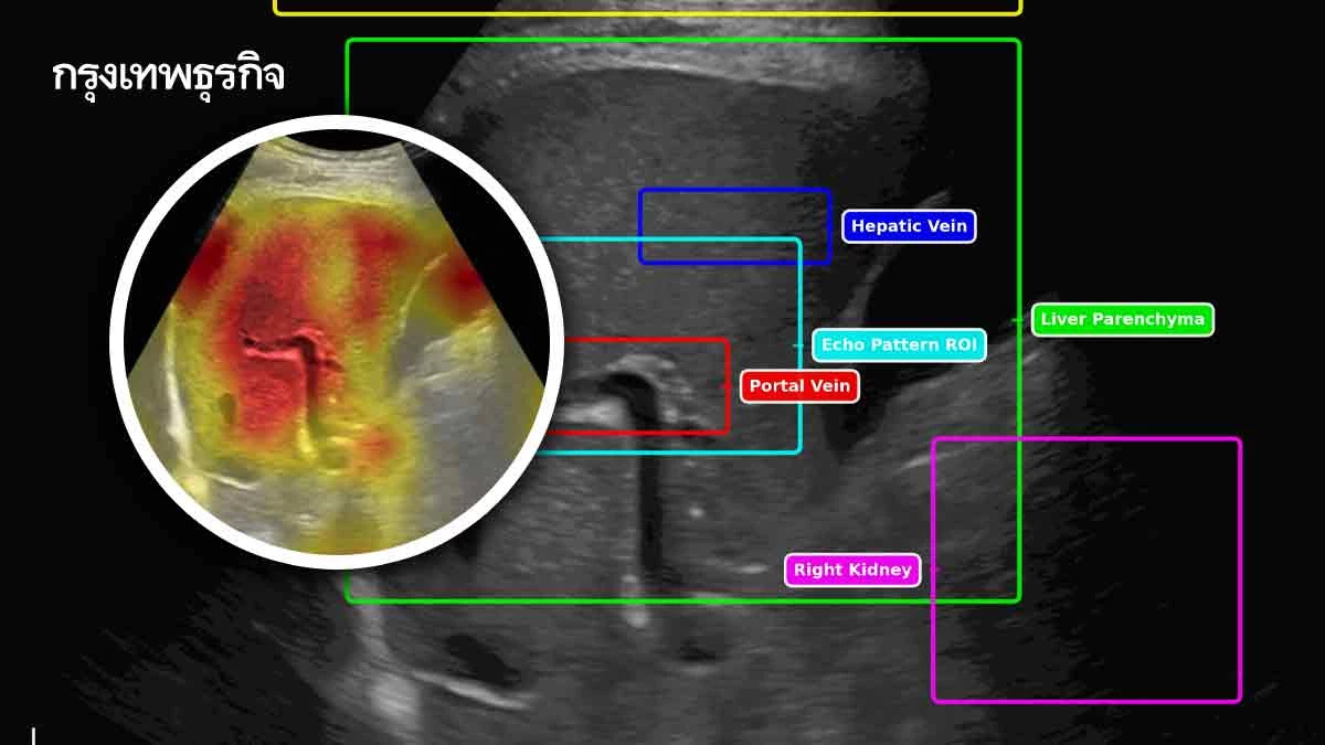 SmartLiva ไอเดียนักศึกษามจธ.  AIตรวจค่า‘ตับ’รู้ผลใน 7 วินาที