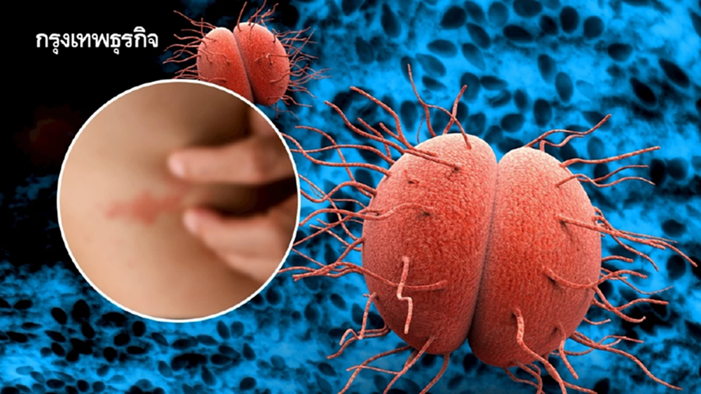 ‘ไข้กาฬหลังแอ่น’ ในไทย  อัตราป่วยและเสียชีวิตอยู่ที่ 13 %