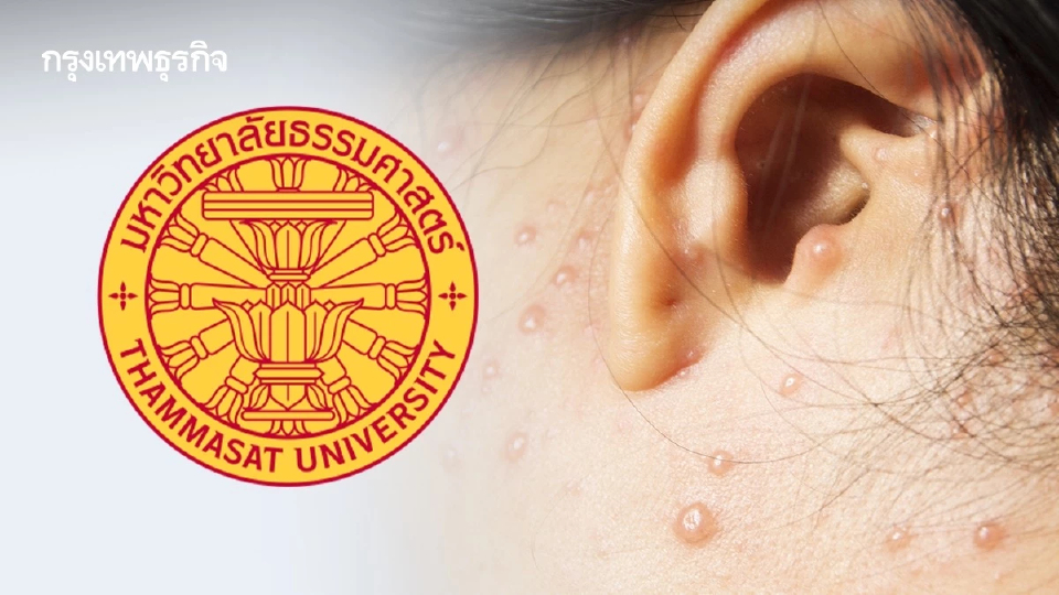 ด่วน! มธ.รังสิต สั่งปิดคณะหนี อีสุกอีใส ระบาดหนัก ให้เรียนออนไลน์