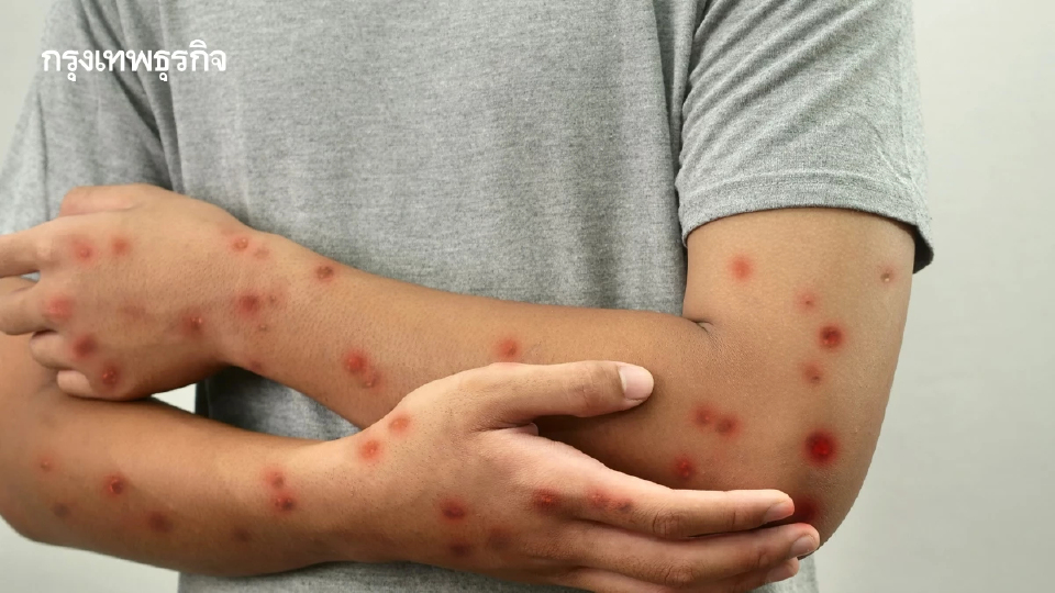 กรมการแพทย์ เผยอาการแทรกซ้อน 'โรคอีสุกอีใส'  คนภูมิต่ำ เชื้ออาจกระจายไปอวัยวะภายใน