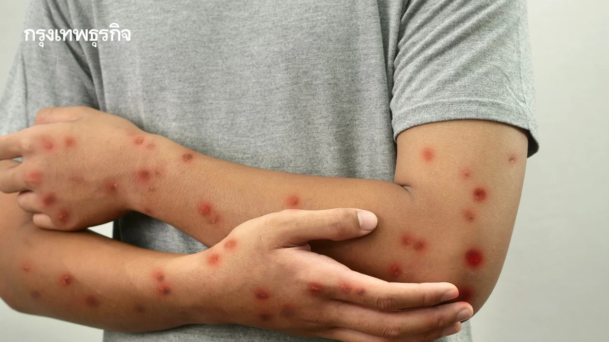 กรมการแพทย์ เผยอาการแทรกซ้อน 'โรคอีสุกอีใส' คนภูมิต่ำ เชื้ออาจกระจายไปอวัยวะภายใน