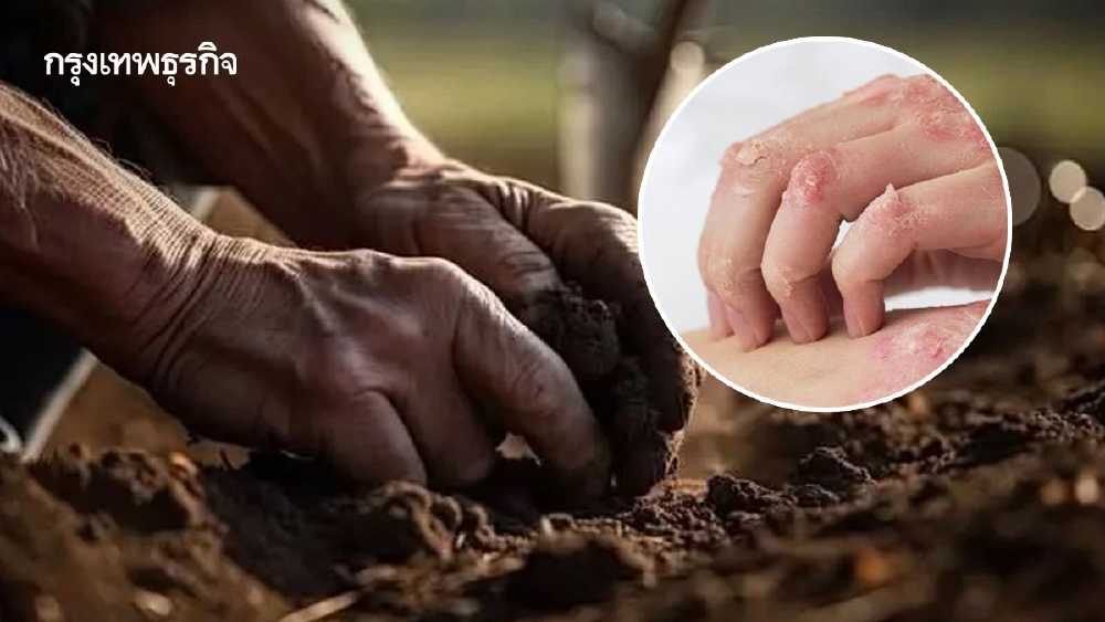 โรคไข้ดินล่าสุด ตาย 23 ป่วยสะสมทั่วประเทศ 732 เตือนชาวกรุงเช็กด่วน