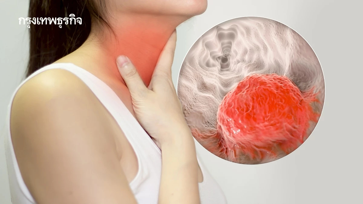 'โรคมะเร็งหลอดอาหาร' กลืนลำบาก กรดไหลย้อนเรื้อรังเกิน 5 ปี มีความเสี่ยง