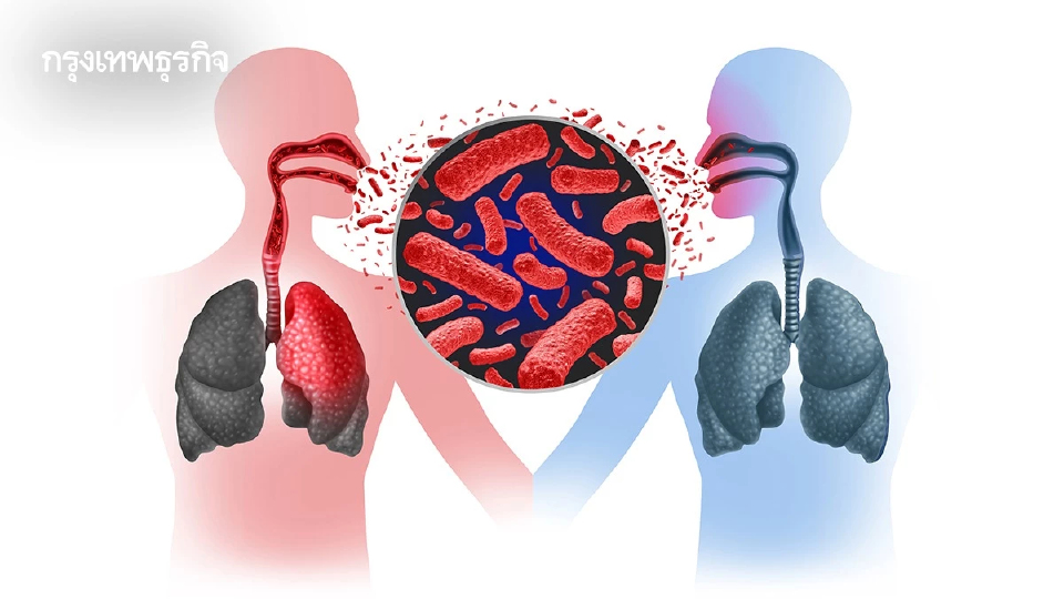 คนไทยต้องรู้! 1 ใน 4 มีเชื้อวัณโรคแฝง เช็กอาการด่วนถ้าไม่อยากป่วยหนัก