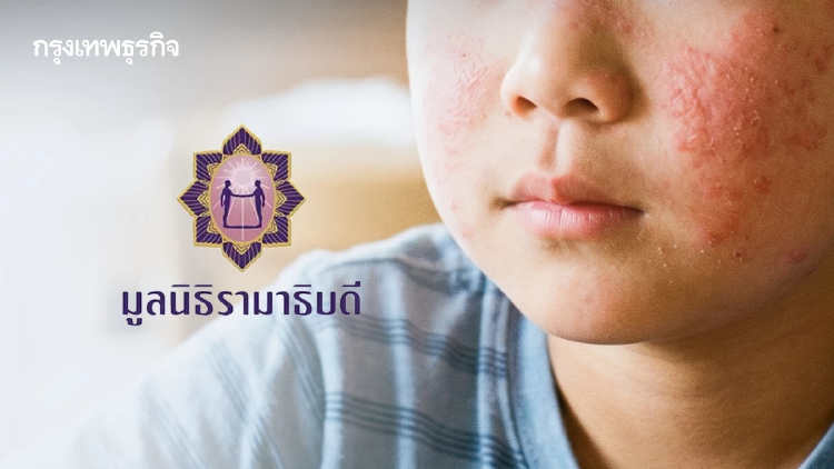 มูลนิธิรามาธิบดีฯ ชวนร่วมมอบ โอกาสในการรักษา ให้ผู้ป่วยเด็กโรคแพ้ภูมิตนเอง