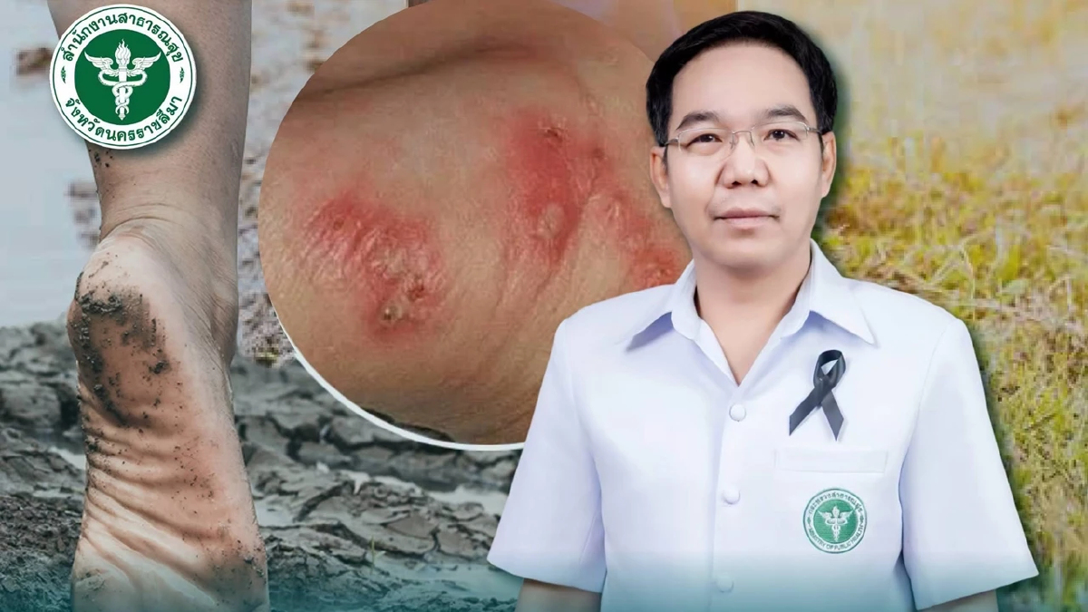 โคราชตายแล้ว 15 ราย โรคไข้ดินแนวโน้มพุ่งสูงปลายฝน แจ้งเตือนด่วน